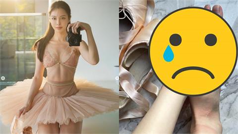 鋼琴女神跳芭蕾「超狂背肌」化身雪白天鵝　親曝「美麗代價」惹萬網心疼！