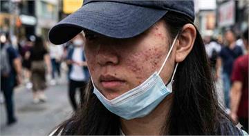 滿臉「痘」花好焦慮！痘疤、凹疤怎處理？誰適合痘疤手術？醫提「4大」關鍵