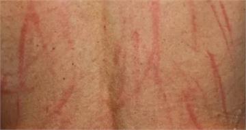 6旬婦身上驚見「鬼抓痕」跑寺廟祭改無效 醫揭:肝求救訊號