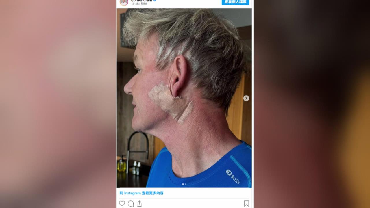英國廚神戈登證實罹患皮膚癌　幽默自嘲「沒拉皮」