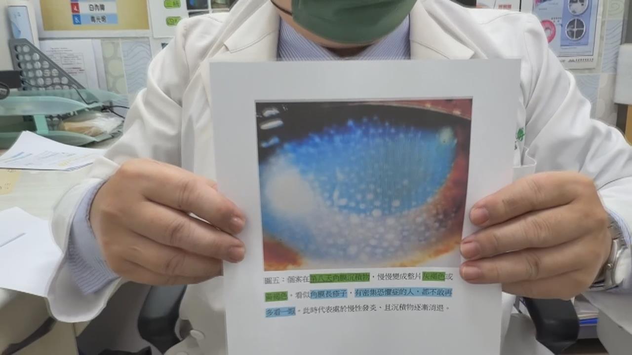 女子長時間待高溫又熬夜　急性葡萄膜炎視力僅0.2