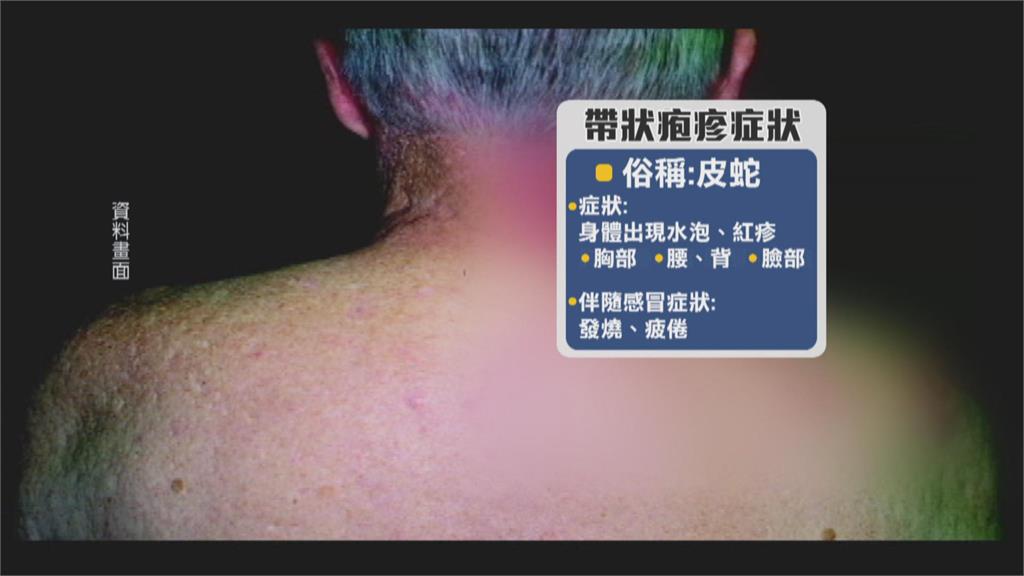 降溫小心！　慢性病、免疫力低落族群　當心「帶狀疱疹」