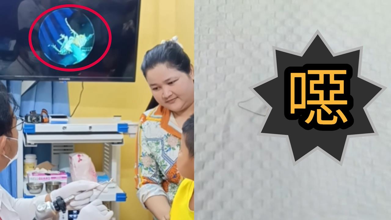 有影/柬埔寨男童喊耳痛 醫檢查驚見「活蟑螂瘋狂蠕動」駭人畫面流出
