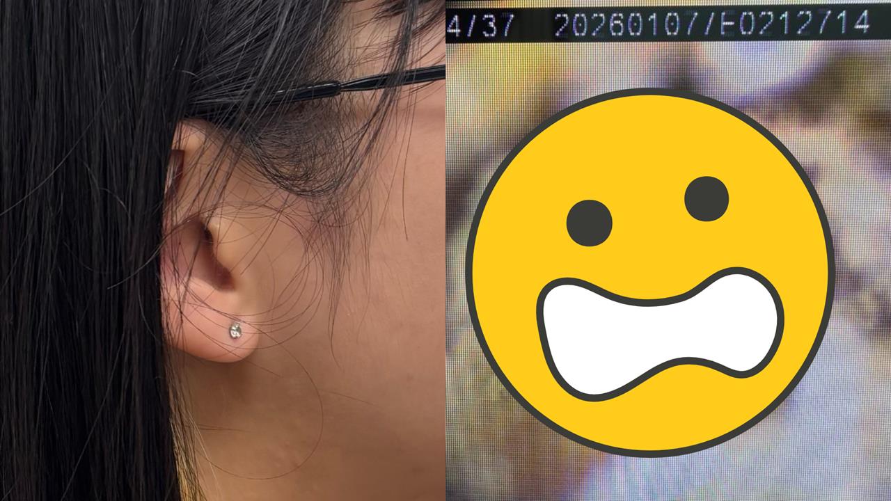 密集恐懼慎入！年輕女耳朵竟「長白香菇」畫面曝光　醫揭「1習慣」惹禍：長黴了