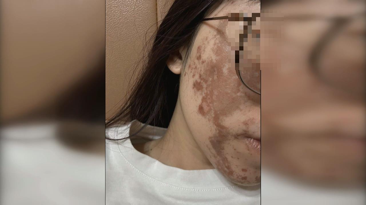 換膚變毀容！美容師疑誤拿高濃度果酸　女臉部大面積灼傷