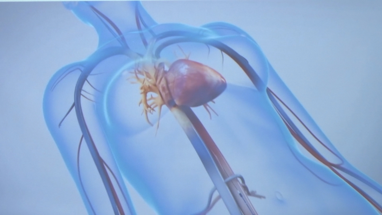 經導管主動脈瓣膜置換術 手術免開胸