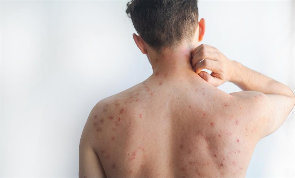 痘痘反覆長？別只顧殺菌！痘痘形成「4大原因」，醫揭「皮脂腺」可能過勞了