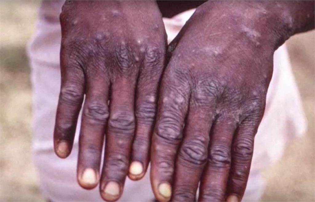 快新聞／猴痘疫情蔓延15國　比利時開第一槍：患者需強制隔離21天