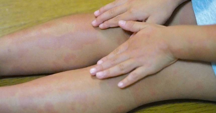 全家衣物混洗「女童長紅疹」元凶是父親香港腳　醫：嚴重恐毀容