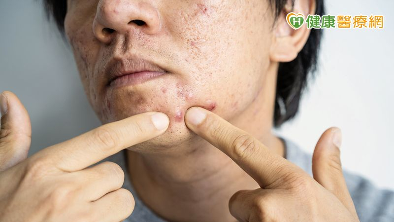 他連吃三天羊肉爐痘痘爬滿臉　醫列進補注意事項：「這些人」注意