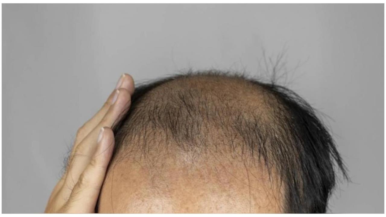 網傳「多吃雞蛋能生髮」他日吞3顆！醫示警1大忌：恐整頭全掉光