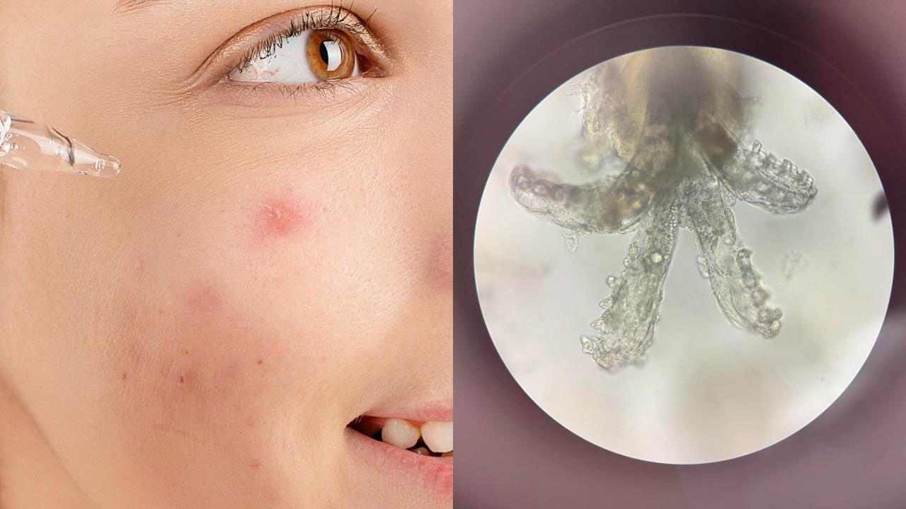 爛痘一年治不好!正妹臉上竟藏「百隻八腳蟲」狂繁殖...醫:妳餵飽牠們