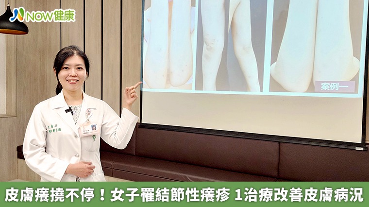 皮膚癢撓不停！女子罹結節性癢疹　1治療改善皮膚病況