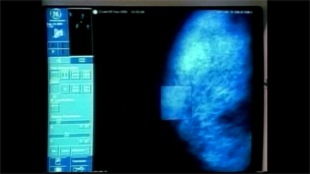 蘇黎世大學出「乳癌地圖」 以人工智慧破解癌症密碼