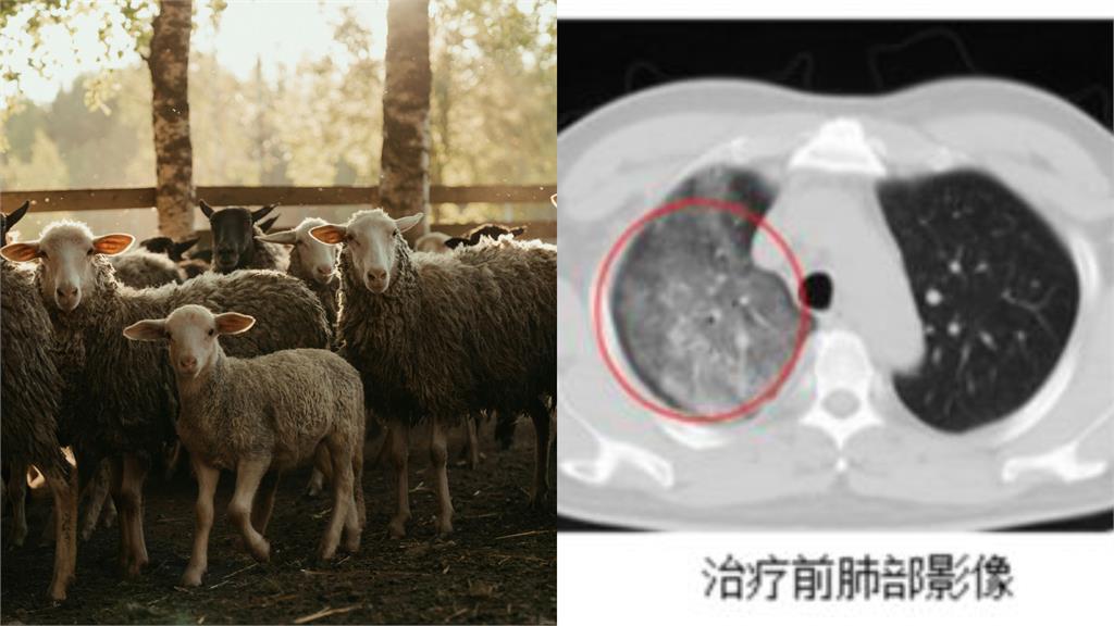 中國驚見人畜共通「罕見傳染病」！至今感染途徑不明…網吶喊：別過來