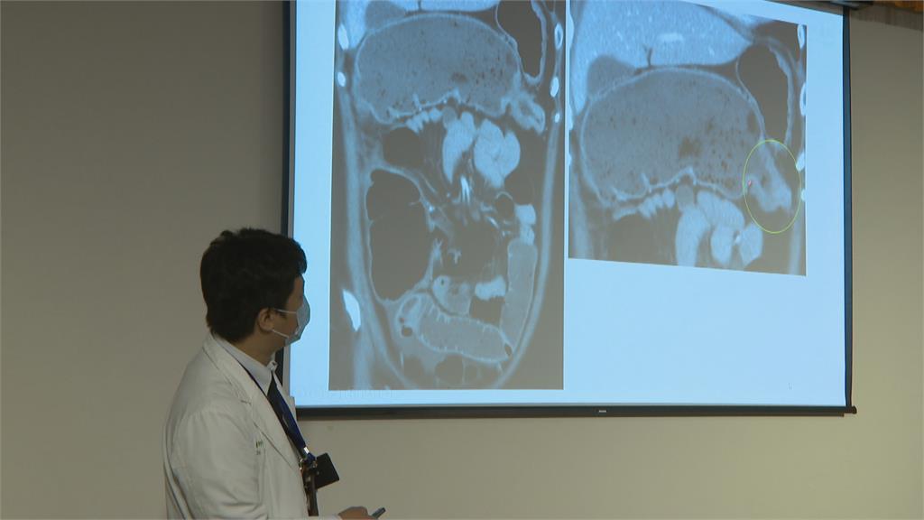 大腸癌警訊！上班族近10天未排便　竟是腫瘤造成「大腸阻塞」