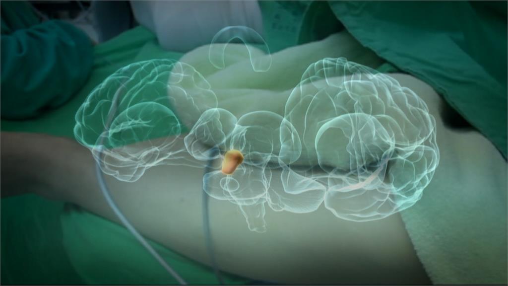 腦癌治療新進展！中研院新技術可提升病患存活期