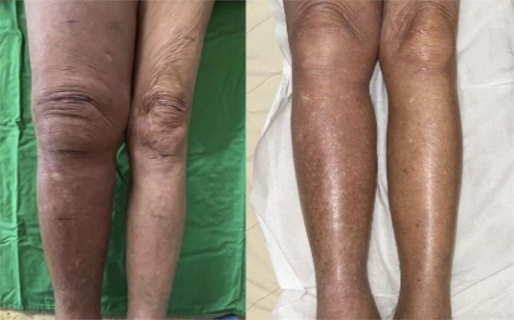 她「一腳水腫3倍大」險長期臥床 醫神手用比髮細縫線吻合血管拆彈