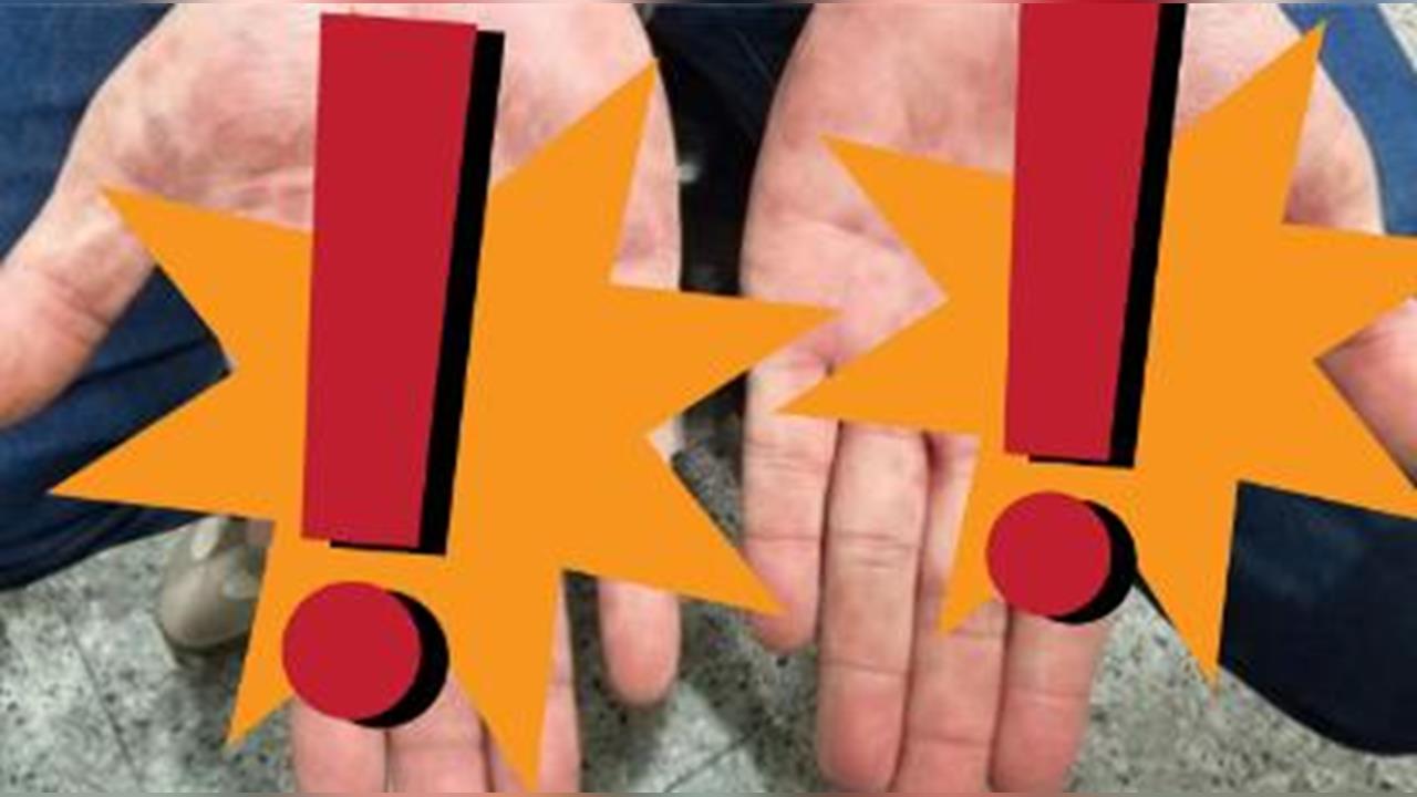 男子露營完手掌出現紅斑「以為被蟲咬」 一問AI竟確診「二期梅毒」!