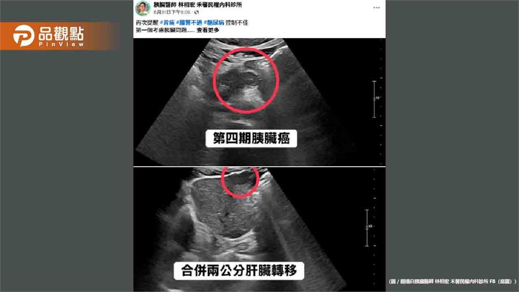血糖失控竟是癌王警訊!50歲男確診胰臟癌四期已轉移肝臟