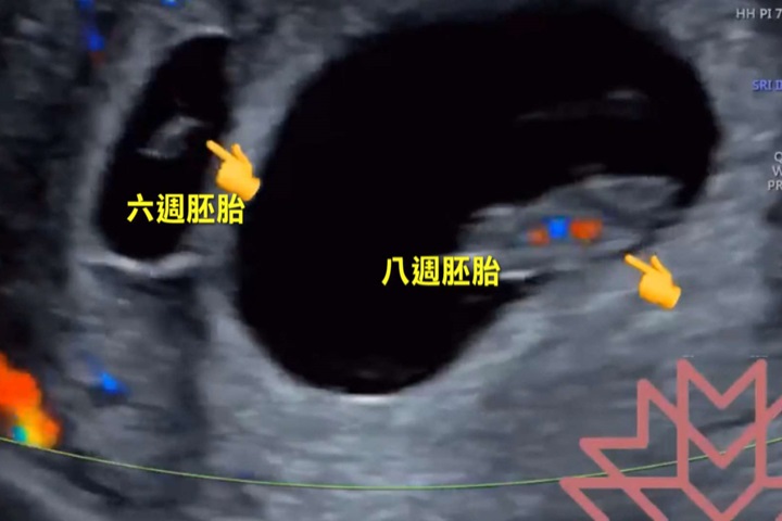 意外驚喜！ 8週孕婦產檢 發現多一個6週胚胎