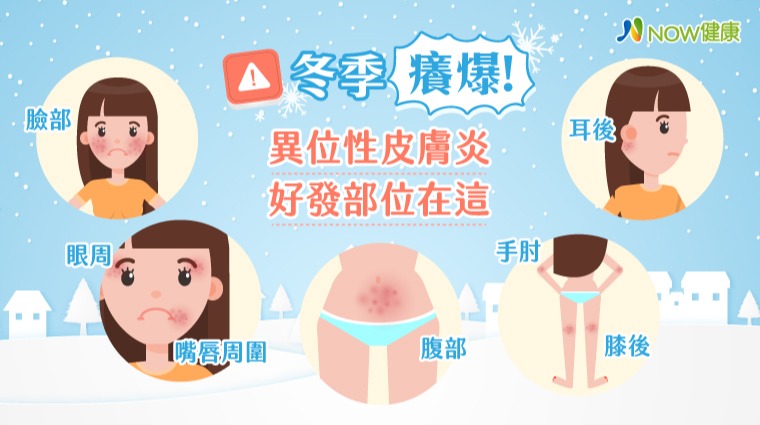 異位性皮膚炎盛行於冬季 尤其這幾個部位特別容易發作
