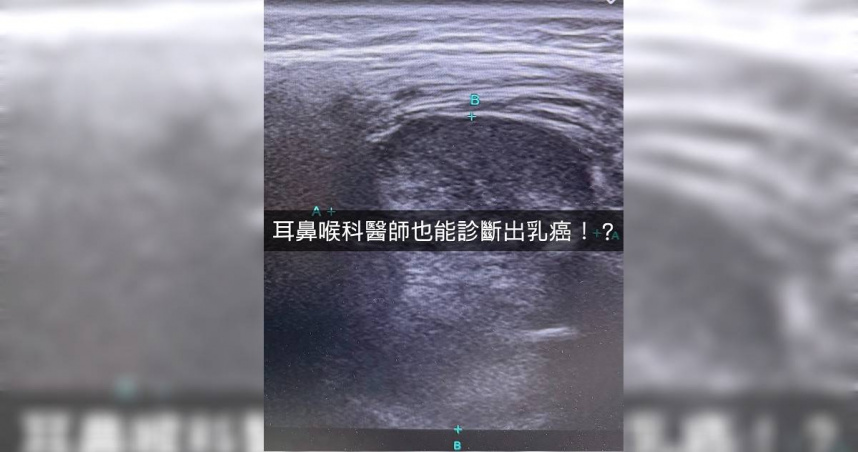 40歲女左臉發麻!看診3個月無效 耳鼻喉科揪出「乳癌轉移下頷骨」