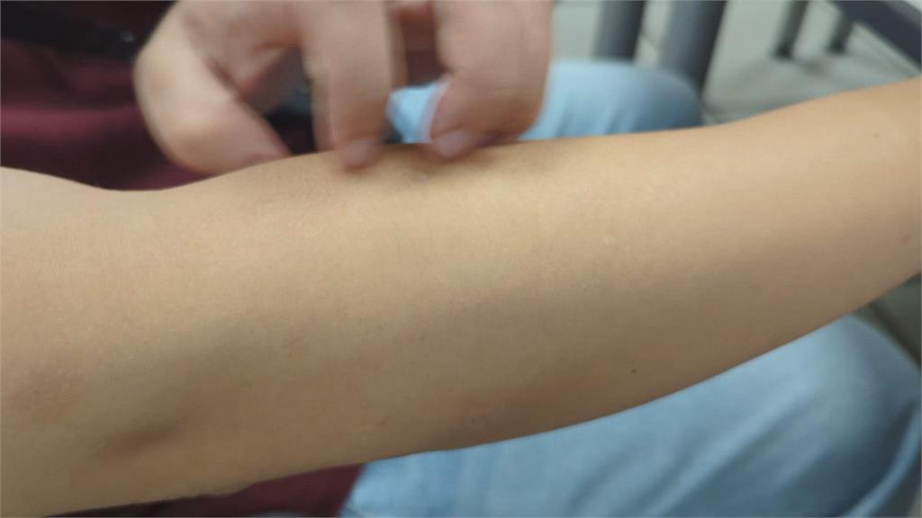 男反覆冒痘流膿  竟是化膿性汗腺炎作祟