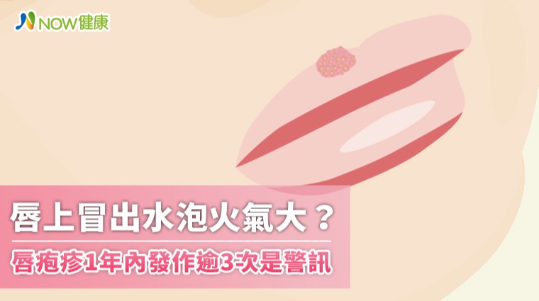 唇上冒出水泡火氣大？ 唇疱疹1年內發作逾3次是警訊
