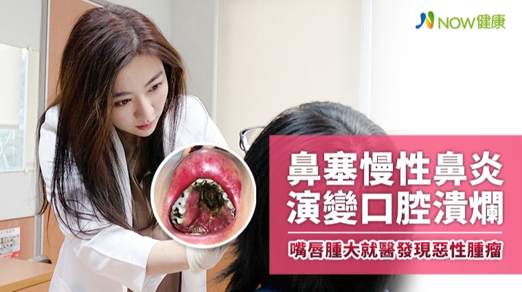 鼻塞慢性鼻炎演變口腔潰爛 嘴唇腫大就醫發現惡性腫瘤