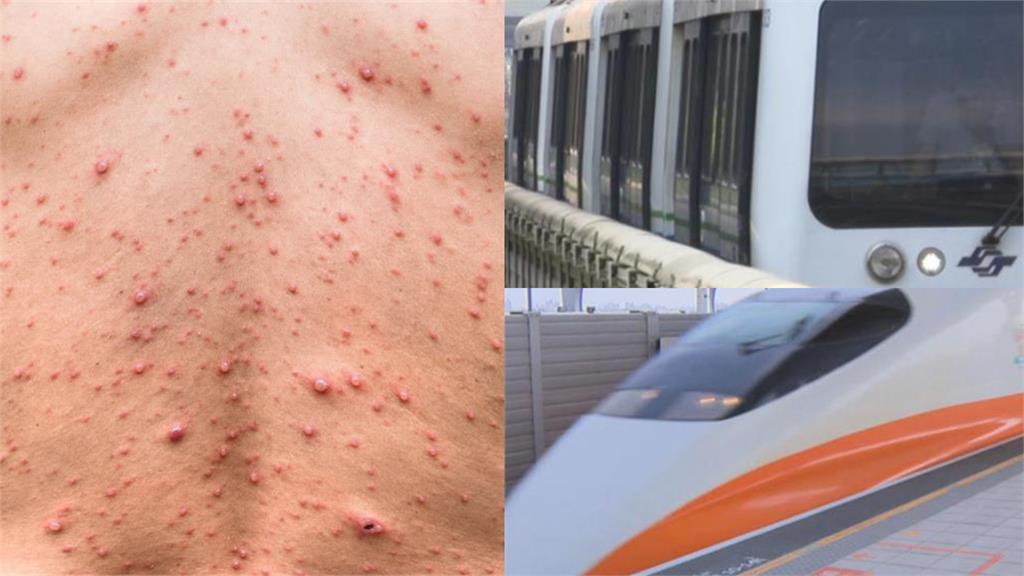 麻疹疫情爆發「個案足跡」曝！衛生局：「尾牙」接觸人數多難匡列