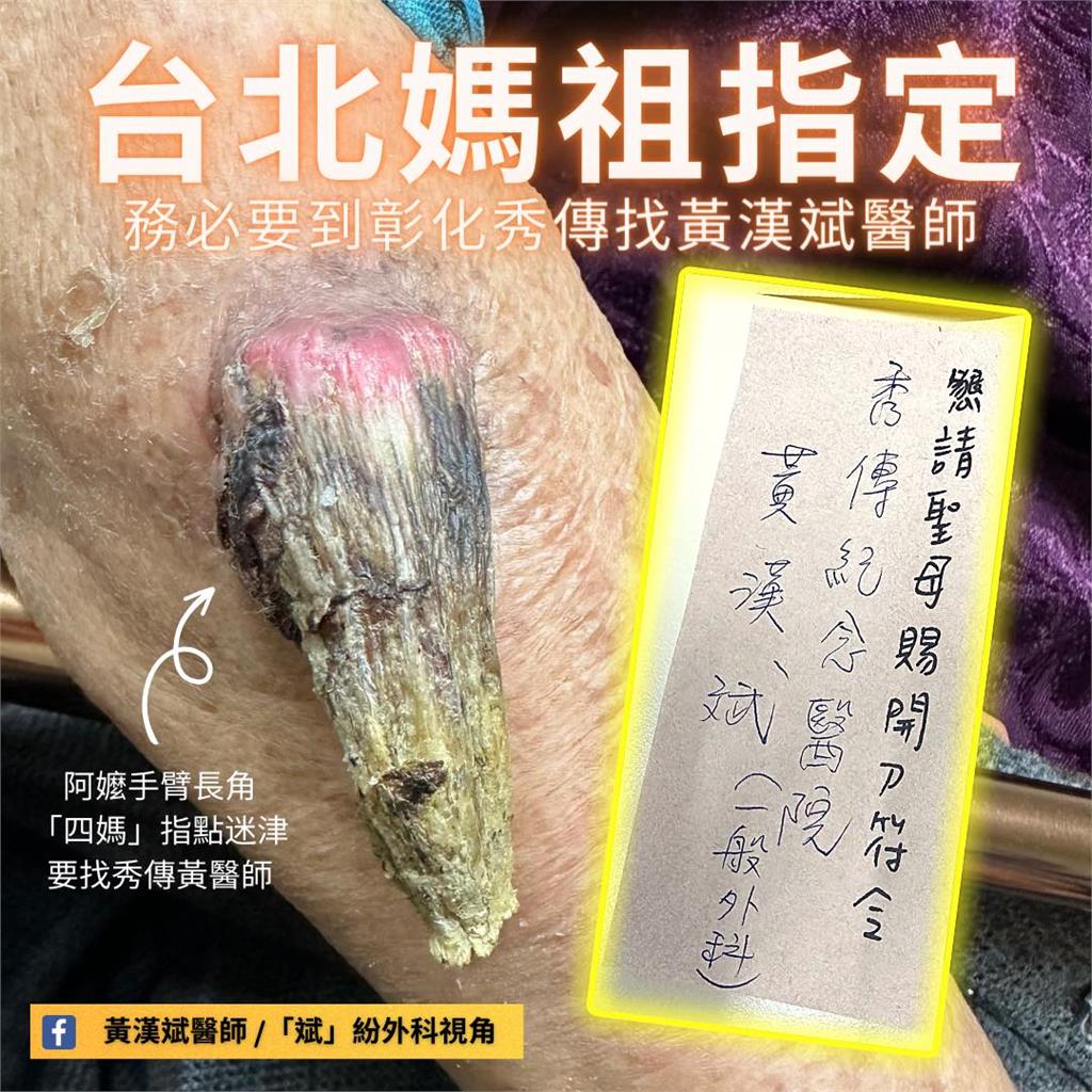 媽祖唯一指定醫師！阿嬤手臂長巨角…「仙界轉診單」指示她找彰化仁醫