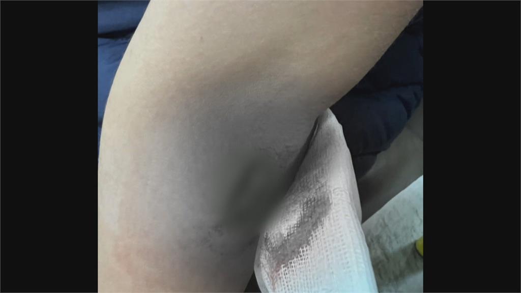 大佳河濱公園設施割傷人　小孩手臂皮開肉綻、送醫縫4針