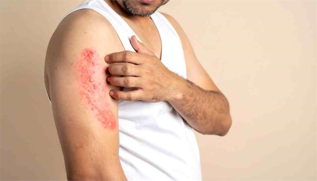 用藥安全⎪致死率達3成的「史蒂芬強森症候群」是什麼？ 出現6大症狀應立刻就醫！