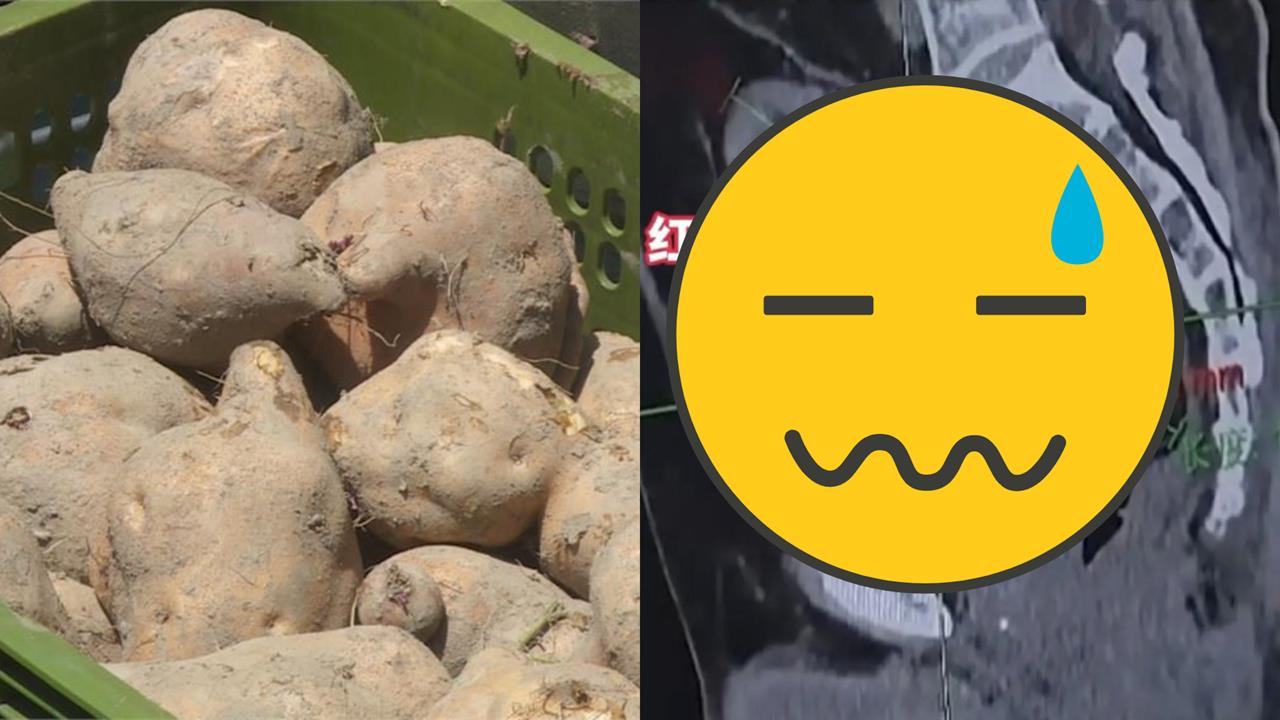 中年阿北後門硬塞「17公分地瓜」卡5小時痛爆！醫傻眼急做「開腹手術」才取出