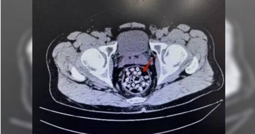 48歲男劇烈腹痛送醫驚見「腸道卡滿果核」　認誤信長輩通便偏方