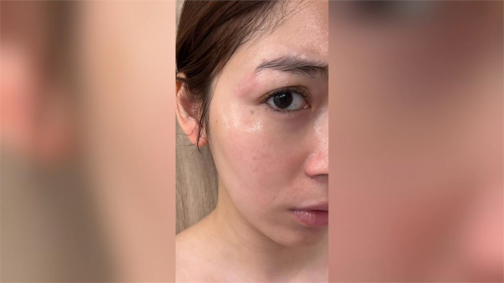 馬來西亞女星東區美髮遭燙傷　指控業者態度消極