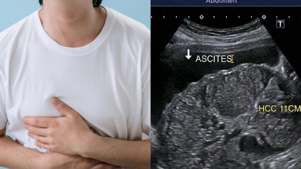 40歲男以為只是「胃脹氣」　醫一查竟發現「這地方」長11公分腫瘤！