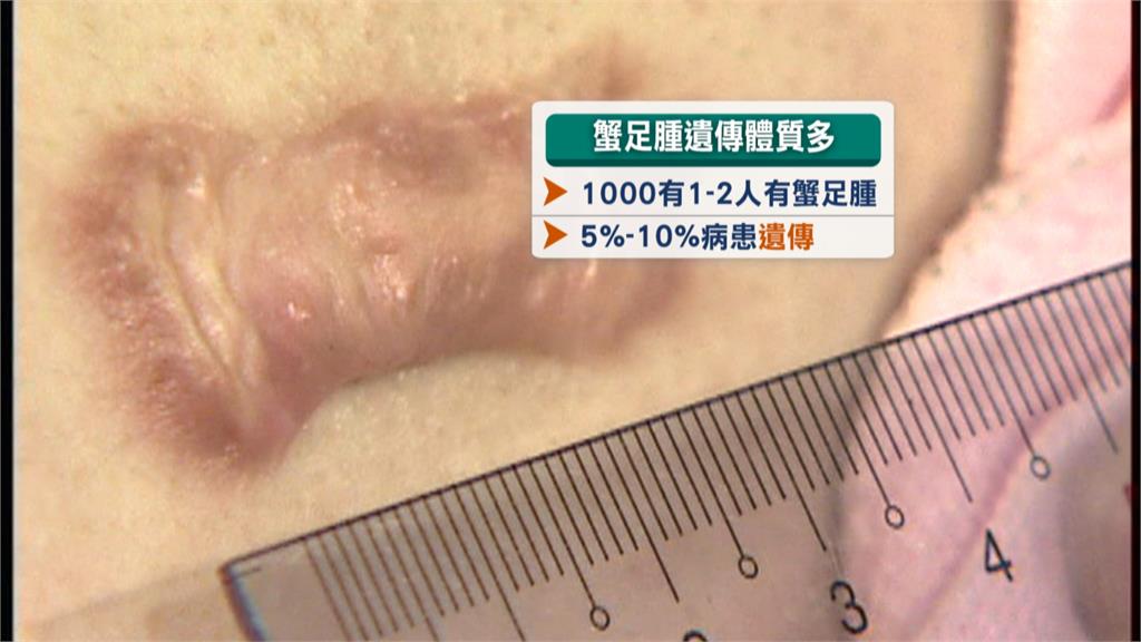 疤痕消不掉、凸起發癢　傷口未正常癒合恐是「蟹足腫」