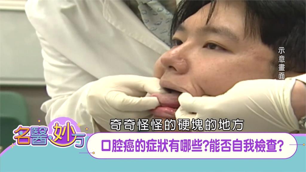 嘴巴裡面摸起來硬硬的而且會痛 小心是口腔癌病徵 建議就醫檢查判斷