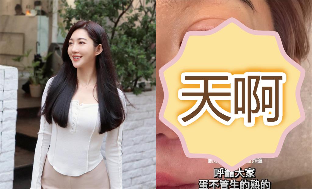 8點檔林志玲「微波爐煮雞蛋」爆炸!眼角膜破洞、皮膚燙傷「送醫慘況曝」