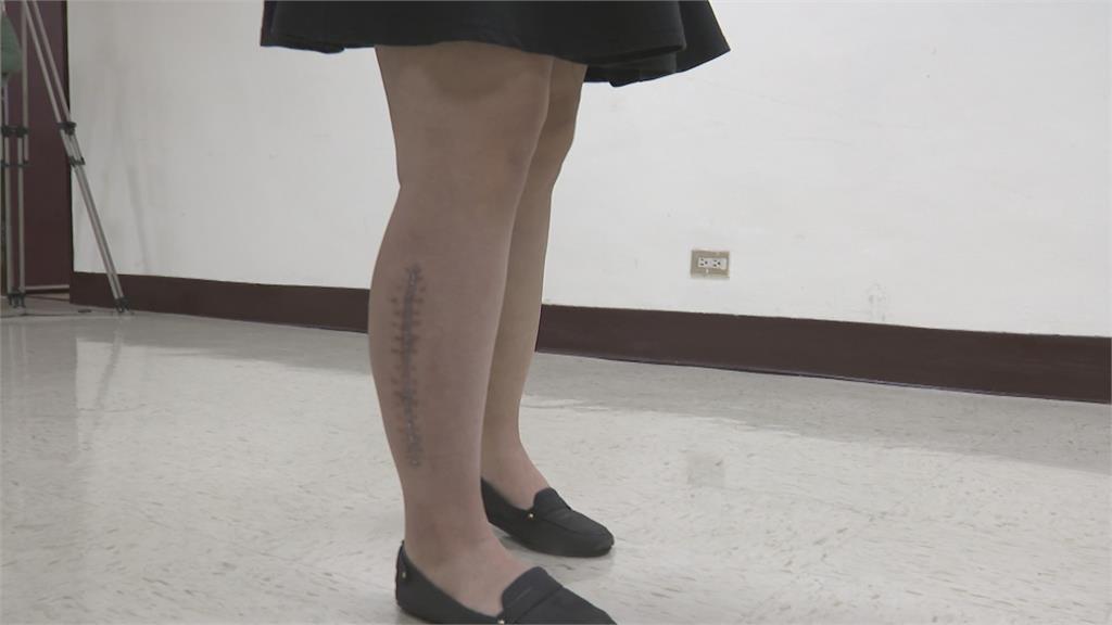 22歲女竟中風!心臟長果凍竟是黏液瘤差點要截肢...12小時搶命成功