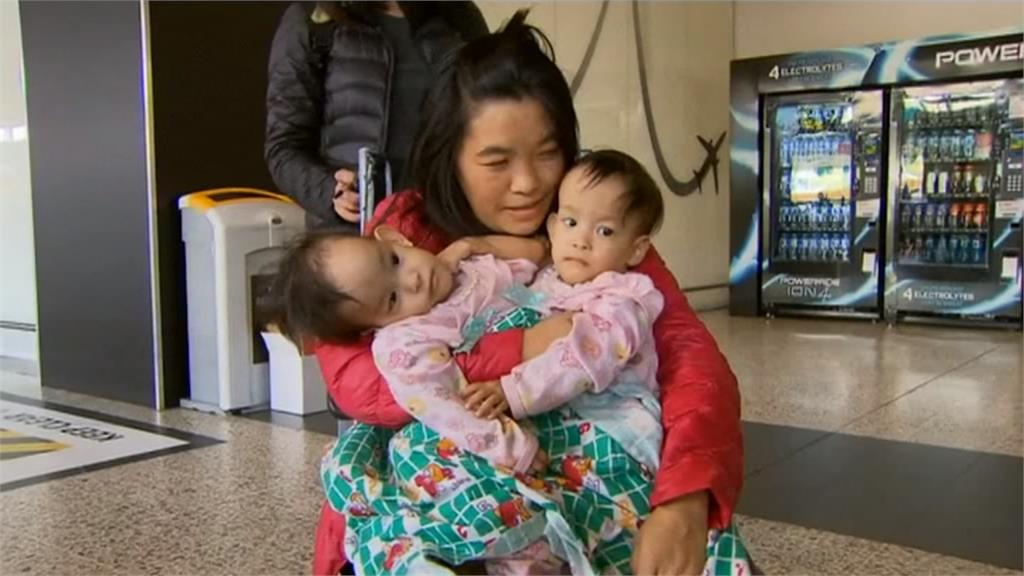不丹連體女嬰抵澳洲 準備進行分割