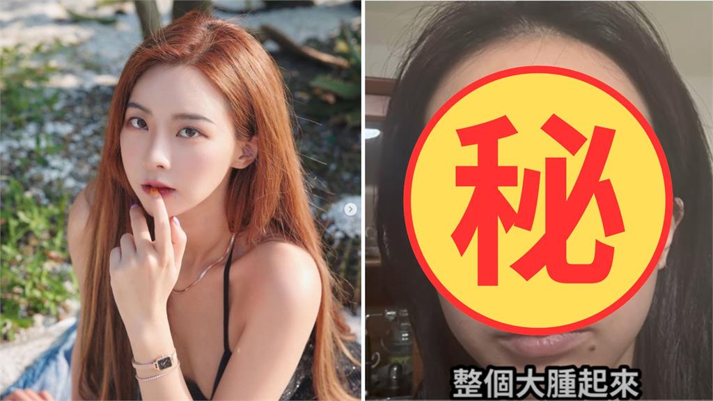 奎丁臉遭細菌入侵「全臉腫到變形+眼下巨大水泡」！坦言：我覺得毀了