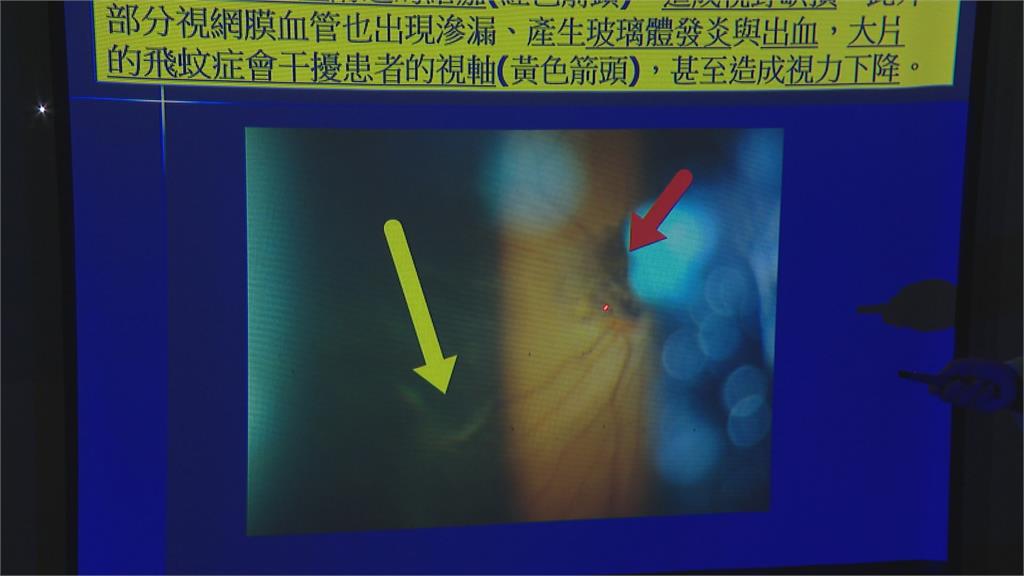 亂吃藥「吞4倍劑量」賀爾蒙藥　53歲女眼內大出血險失明