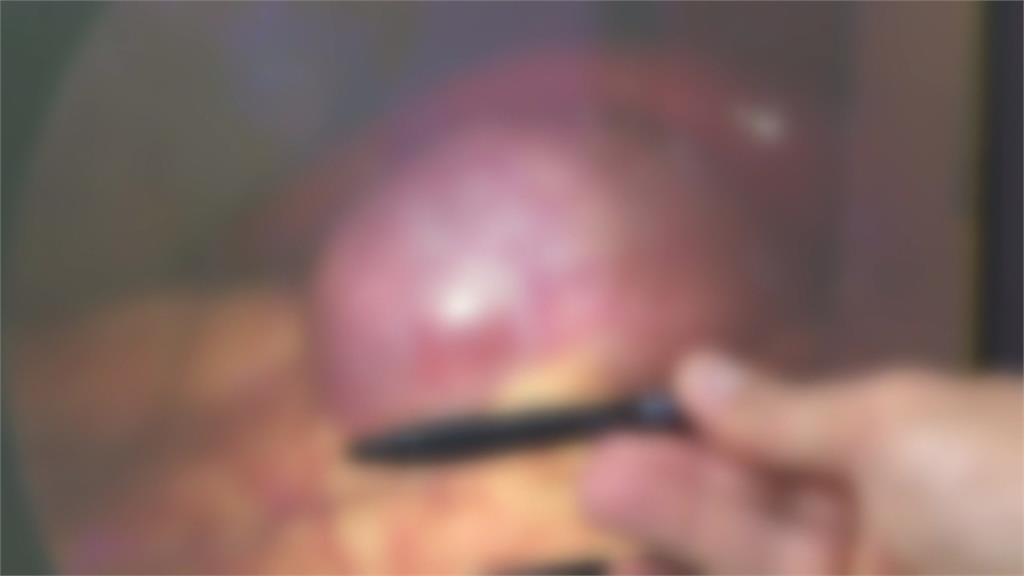 膽結石不是中老年專利！　15歲少年以為胃痛掛急診　檢查出膽囊炎