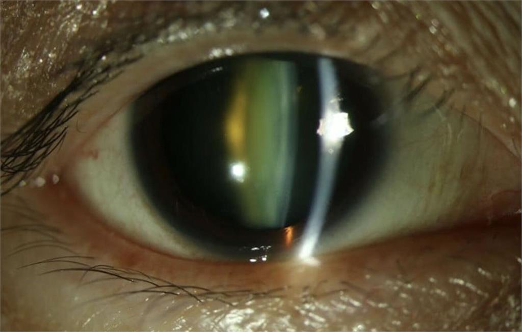 連換多副眼鏡仍看不清? 眼冒「4大症狀」恐已白內障
