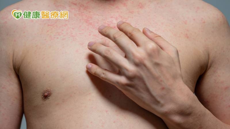熬夜、壓力大當心皮蛇上身！冒紅疹、會癢注意　預防這樣做
