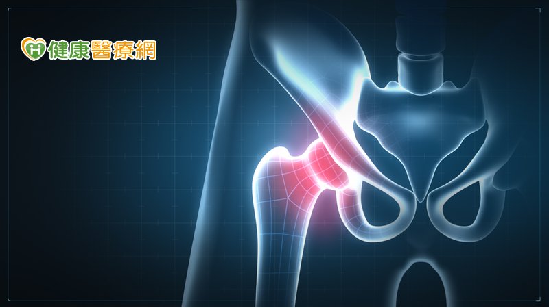 DAA正前開式解決髖關節退化　術後疼痛感低、恢復快