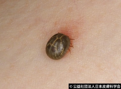 赴日山區注意！　蜱蟲傳染「SFTS」病患創新高　有死亡風險